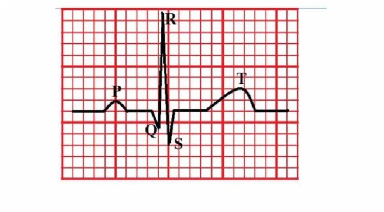 ecg p q s signals